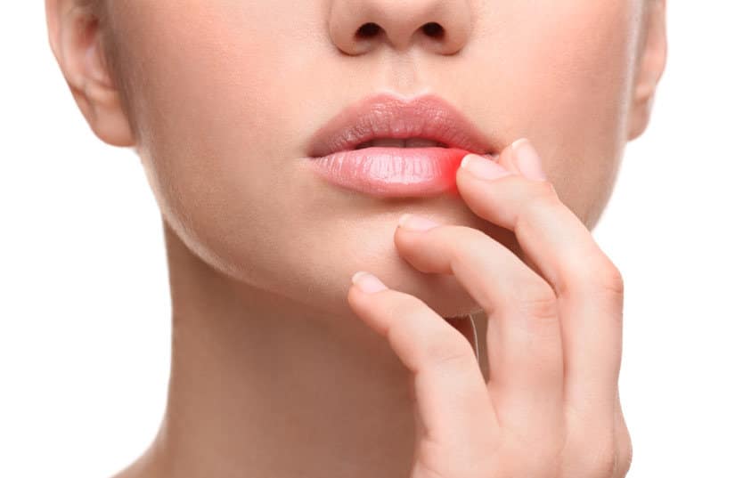Cold Sore Laser Treatment in Chandler