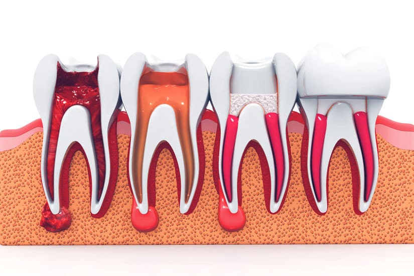 Root Canal Treatment in Chandler, AZ