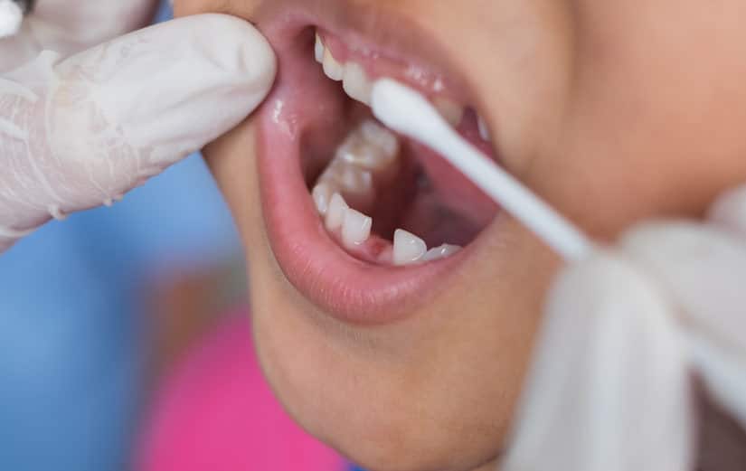 Fluoride Varnish Treatment for Kids