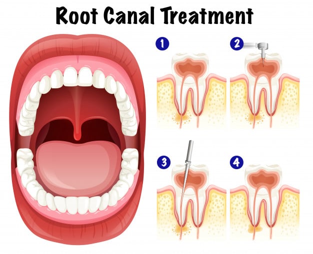 Whats-the-procedure-of-a-Root-Canal-Treatment