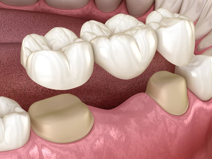 Dental Bridge in Chandler