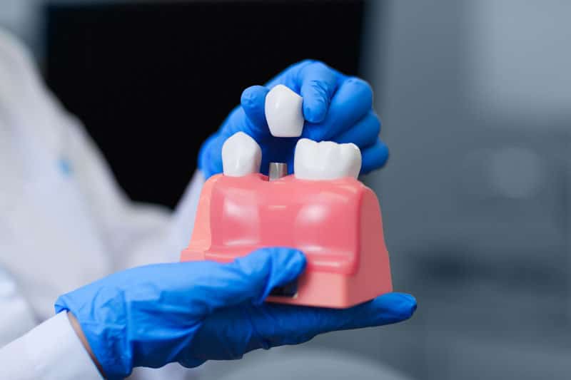 Dental Implants in Chandler