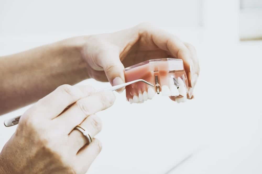 A Quick Guide to Dental Implants: Types, Procedure, and Safety