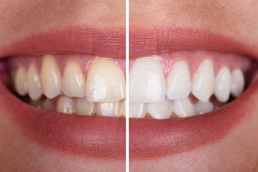 Cost for Teeth Whitening