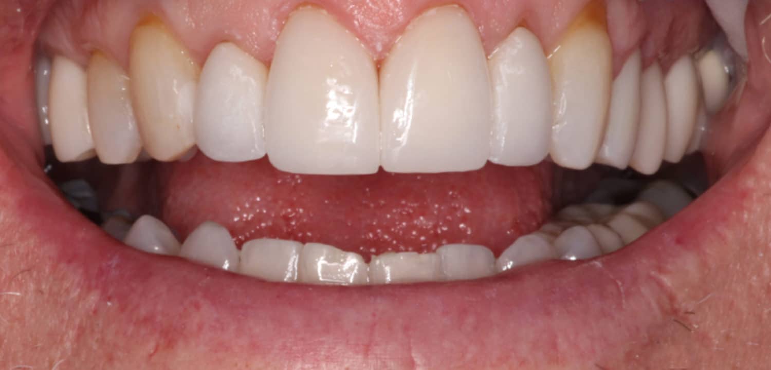 Veneer on chipped front tooth by Dr Silverman Peace of Mind Dental Studio