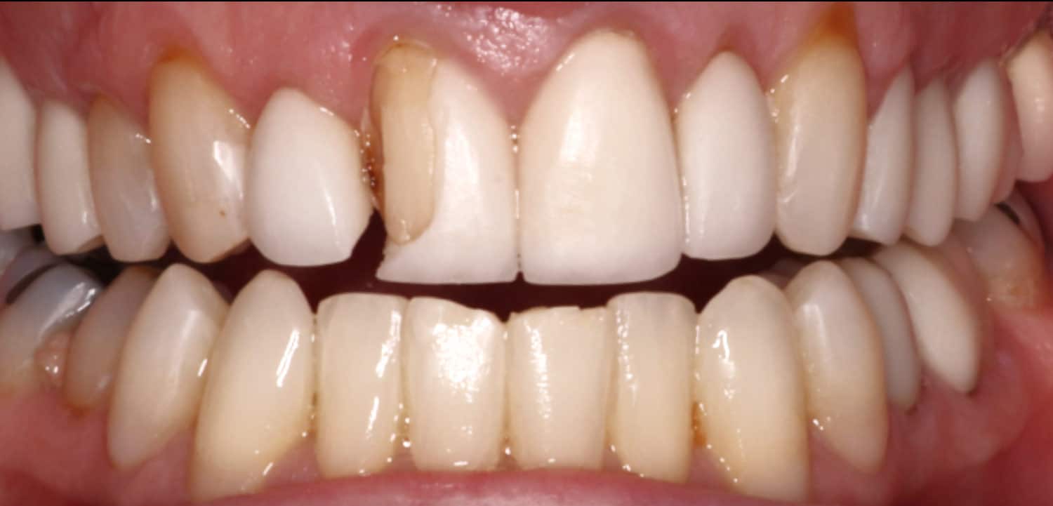 Chipped front tooth needs restoration