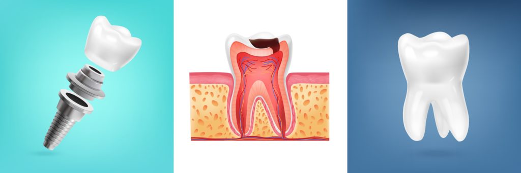 Dental Implant