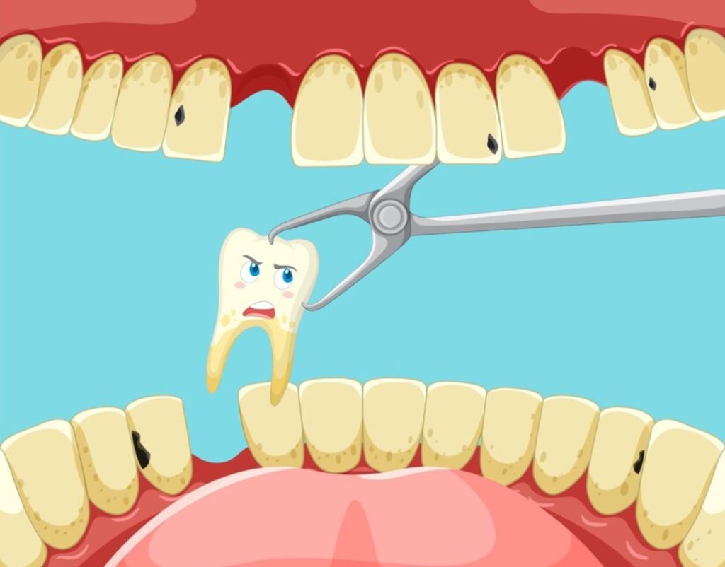 Emergency Dental Extractions