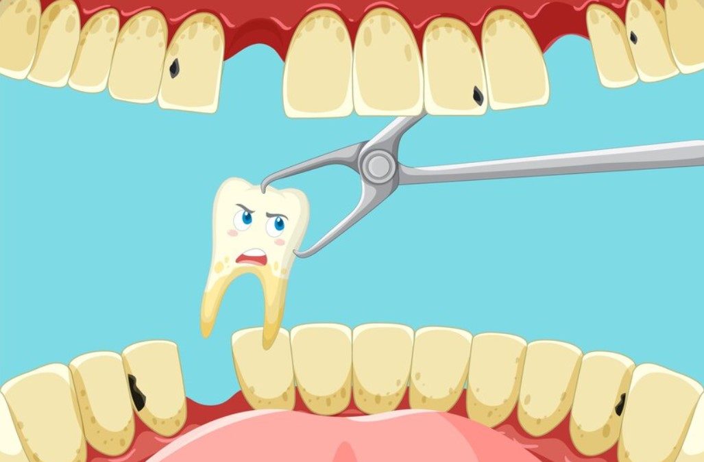 Common Causes of Emergency Dental Extractions
