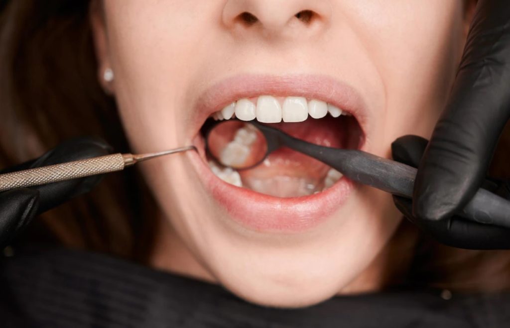 Permanent Tooth Filling