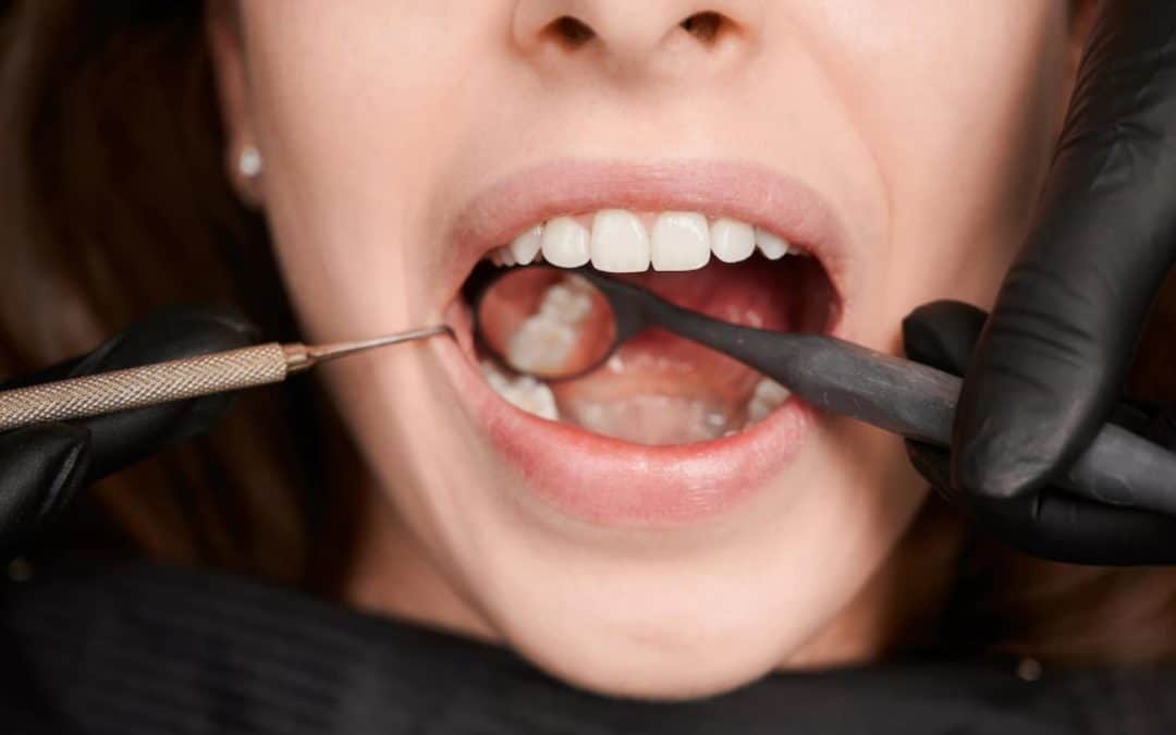 Myths and Facts About Permanent Tooth Filling
