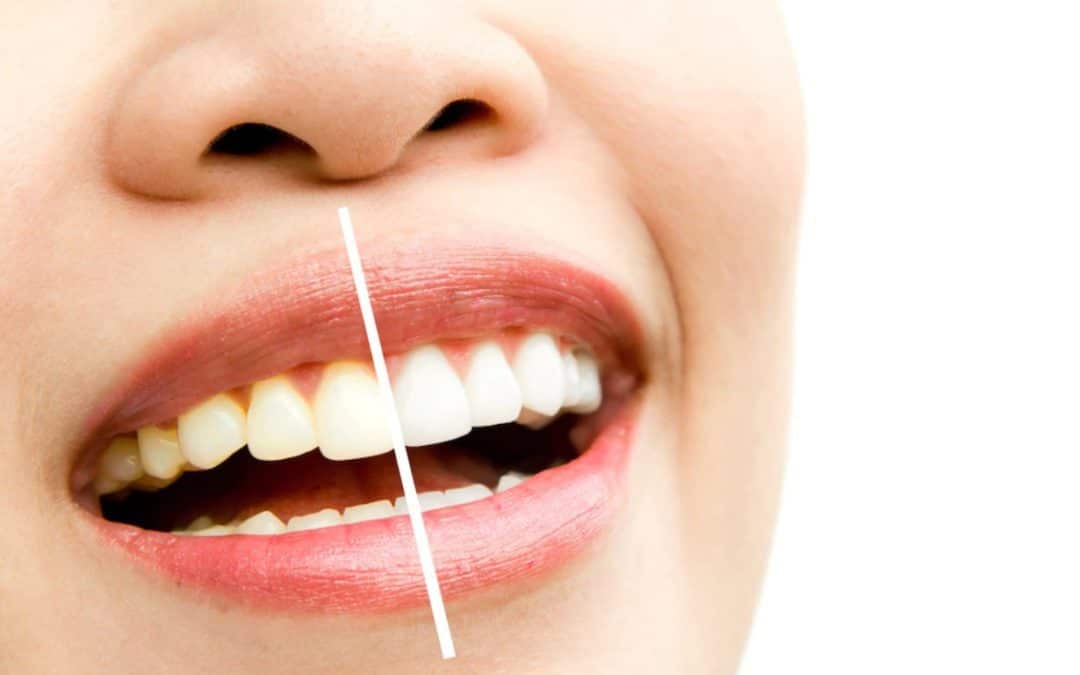 Teeth Cleaning Tips and Secrets