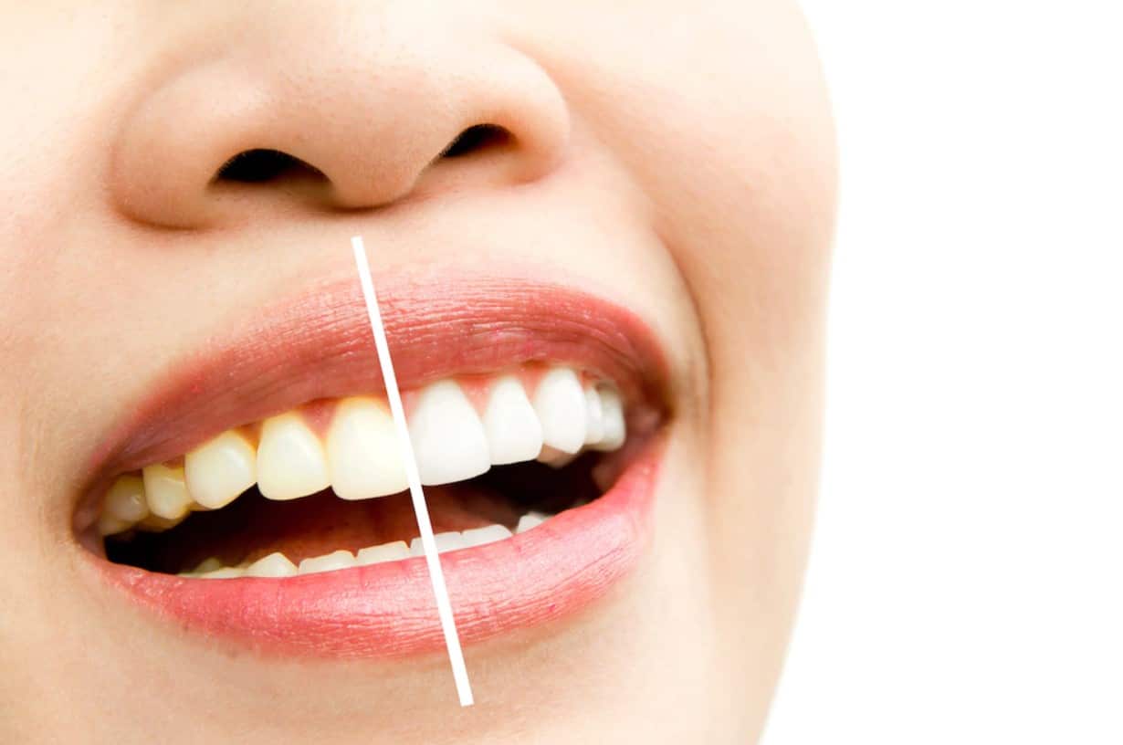 Teeth Cleaning Tips and Secrets
