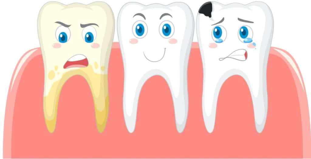 Cavities and Tooth Decay