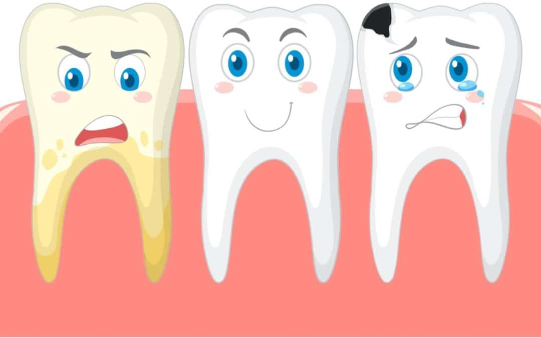 What Causes Cavities and Tooth Decay