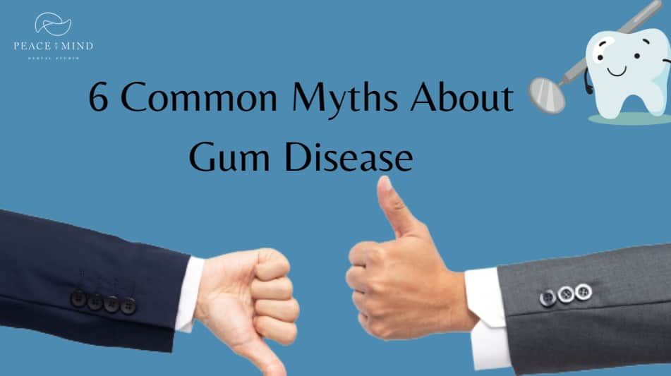 6 Common Myths About Gum Disease