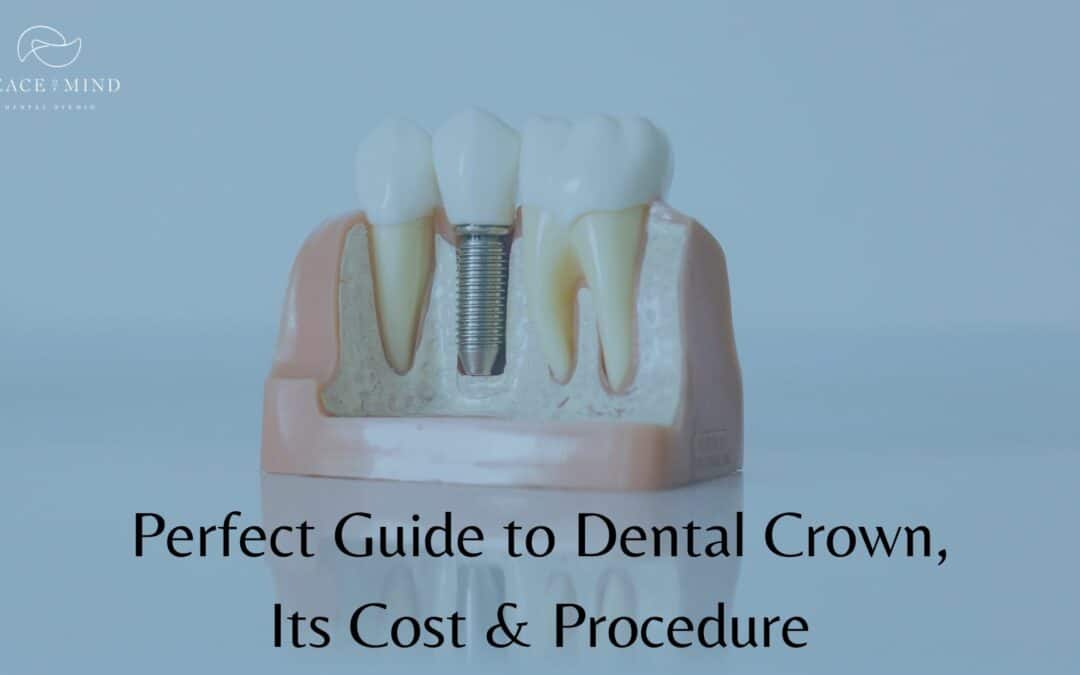 Perfect Guide to Dental Crown, Its Cost & Procedure