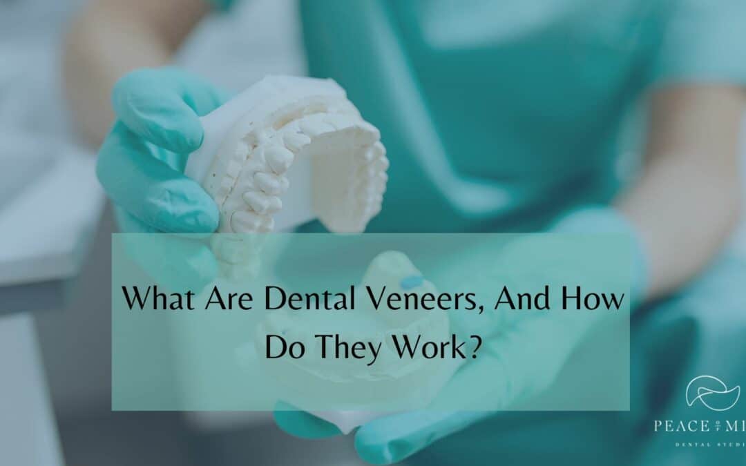 What Are Dental Veneers, And How Do They Work?