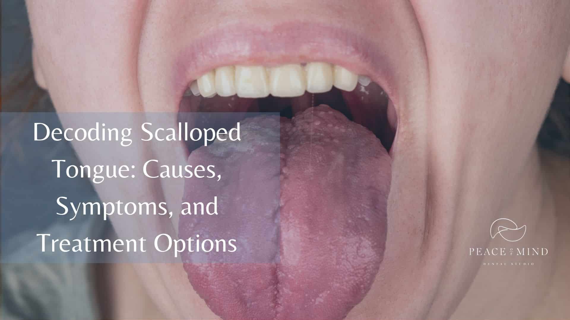 Decoding Scalloped Tongue: Causes, Symptoms, and Treatment Options - Peace  of Mind Dental
