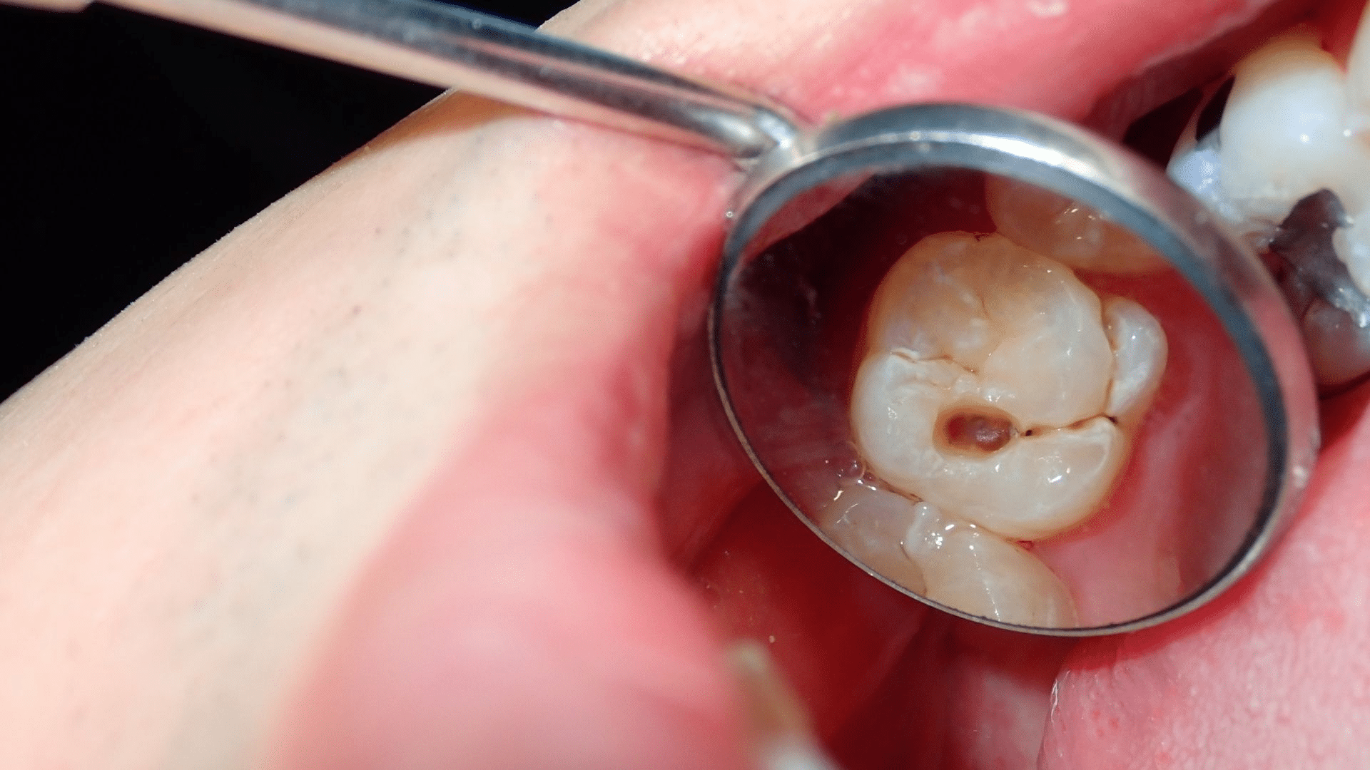 Effective Cavity Treatment