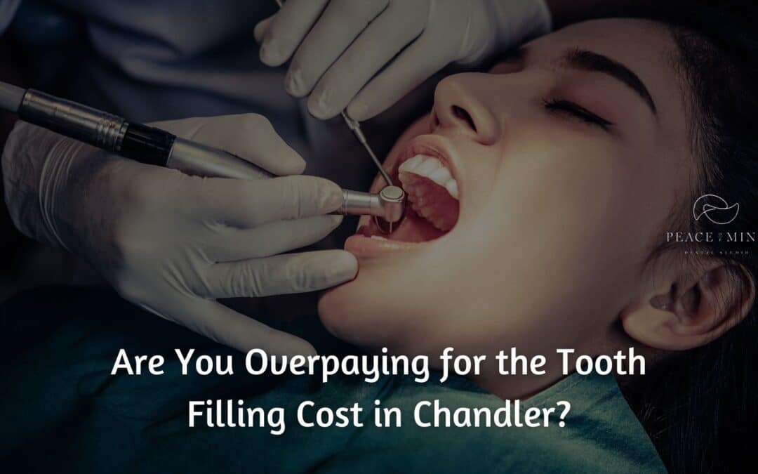 Are You Overpaying for the Tooth Filling Cost in Chandler?