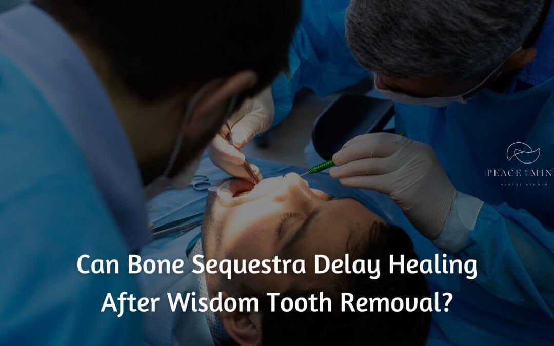 Can Bone Sequestra Delay Healing After Wisdom Tooth Removal?