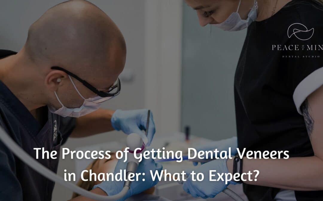 The Process of Getting Dental Veneers in Chandler: What to Expect?