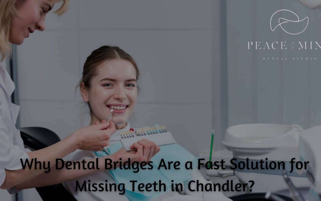 Why Dental Bridges Are a Fast Solution for Missing Teeth in Chandler?
