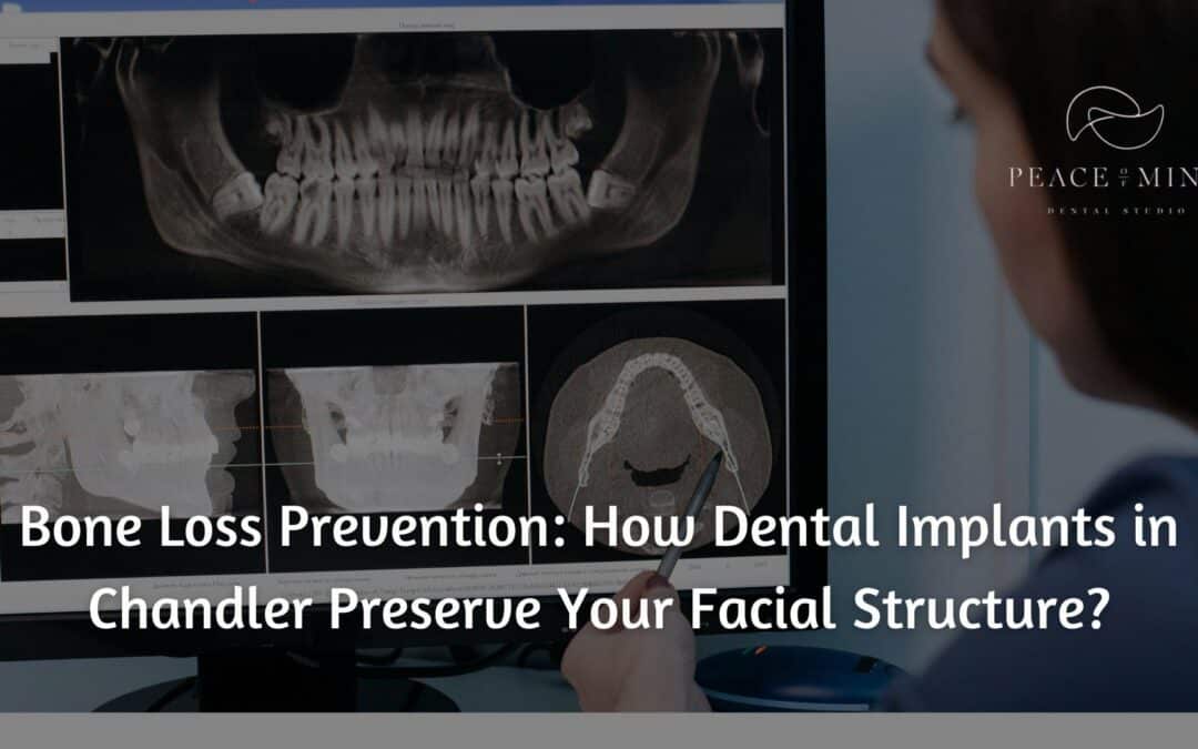 Bone Loss Prevention: How Dental Implants in Chandler Preserve Your Facial Structure?