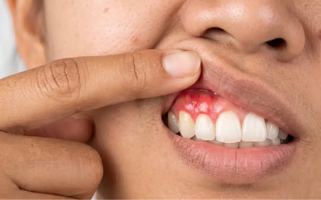 Gum Recession: Causes, Treatment & Can It Be Reversed?