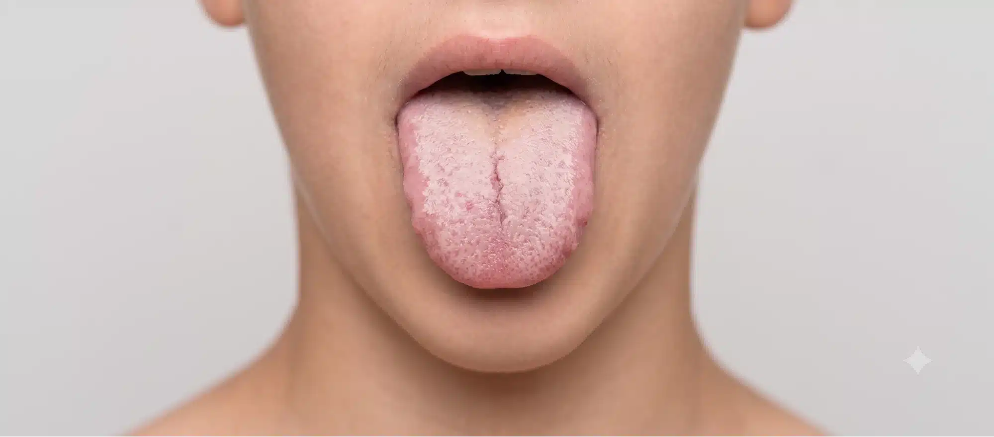 Oral Thrush in Adults: Causes, Symptoms, Treatment and When to See a Dentist